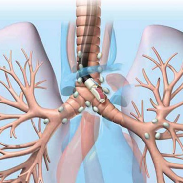 COPD