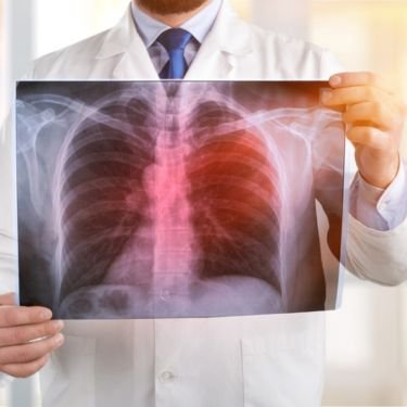 COPD